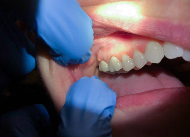 Best Emergency Treatment for Oral Infections in Boscobel, WI